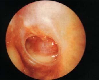 中耳炎常见症状表现有哪些？